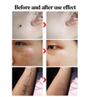 Gen2 Blue Light Picosecond Laser Tattoo Removal Pen Mole Dark Spot Remover