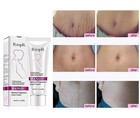 Mango Stretch Marks And Scar Cream -stretch Marks And Scar Removal Cream