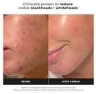 Paula s Choice 2  Bha Liquid Exfoliant Salicylic Acid Face Toner Pore Care