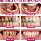 Denperm Cavity Repair Natural Enamel Filling Gel  Nh-10  Gentle Oral Care  3ml 3
