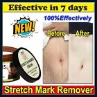 Scar Removal Cream For Surgical Scars Burns Stretch Marks Acne Spots Repair New