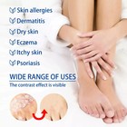 2 X Psoriasis Dermatitis Eczema Natural Cream Skin Ointment 20g
