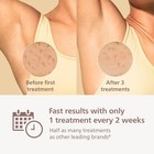 Philips Lumea 9000 Series Ipl Hair Removal Device - Luxury Beauty Box Bri984 New