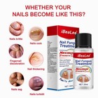 Ibealee Nail Fungus Treatment 7days Extra Strong Repair Essence Serum For Nails