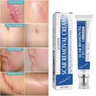 Scar And Acne Mark Removal Cream Remove Scars Burns Stretch Marks