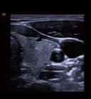 Mindray Te Air E5m Wireless Handheld Ultrasound  Color Doppler  Ineedle