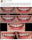 Dlp Sla Lcd 3d Printer Permenant Crown - Teeth Resin   