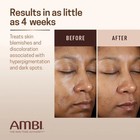Ambi Skin Dark Spot Fade Cream Lightening Cream Dark Spot Whitening