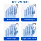 Ergonomics Bunion Fix Toe Valgus Corrector Adjustable Orthosis Women Men Splints