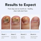 Lunavia Antifungal Pen     25  Undecylenic Acid  Toenail Fungus Treatment Extra St