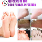 Foot Fungus Relief Cream     Anti-itch Moisturizing Foot Cream For Dry Cracked Ski