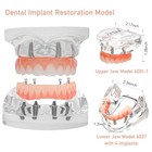 Us Dental All-on-4 Overdenture Implant Model  Upper lower Jaw-clear with 4 Screw