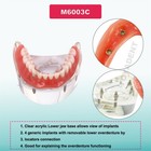 Dental Implant Teeth Demo Overdenture Restoration With 4 Implants Upper lower Us