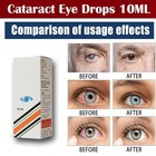 Best Cataract Eye Drops - Glaucoma  Non Carnosine  Can Cataracts C Pack 2