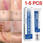 1-5 Pcs Scar Removal Cream Skin Repair Scar Remover   fade Stretch Mark   acne
