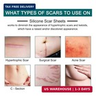 Silicone Scar Sheets  1 6  X 120  Roll-3m   Silicone Scar Tape Roll  Scar Silico