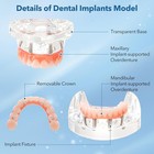 New Dental Implant Model All-on-4 All-on-6 Overdenture U l Jaw 4 6 Screws Clear