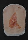 Antique Anatomy Art Print Medical Human Disease Halloween Original 1914