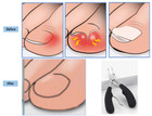 Toenail Clippers For Thick Ingrown Toe Nails Heavy Duty Precision Nail Scissor