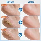 4 Pack 60  Urea Foot Cream Stick 2  Salicylic Acid For Dry Cracked Skin 80g