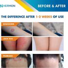 Powerful Antifungal Ringworm Cream - Effective Treatment For Stubborn Ringworm