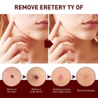  final Sal  Skin Tags   Moles Removal Quick Safe Remover Restore Skin 3ml Us