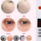 1pcs Beauty Monster Plasma Pen Skin Repair Freckle Scar Acne Pigment Removal