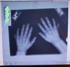 Polydactyly Radiograph Vintage Real Xray Extra Fingers Birth Defect Human Oddity