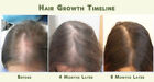 Best Hair Loss Thinning Prevention Regrowth Treatment Kit Men Women Organic Oils