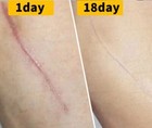 Scar Removal Cream And Laser Treatment Postpartum  Burn Scars Hyperplasia Face