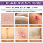 Silicone Scar Sheets silicone Scar Tape silicone Sheets For Scars - 1 6 x 120 in