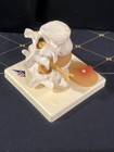 3b Anatomical Spine Lumbar Disc Herniation Anatomy Medical Teaching Tool Model