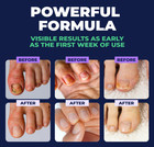 Orivelle Anti Pen  Clear Anti Fungal Pen  Anti Fungal Nail 3ml