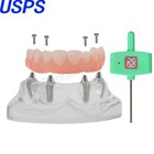 Us Dental Implant Model Overdenture Upper Lower Jaw 4 6 Screws Post Core Bridges