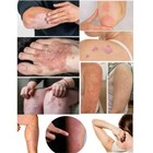 Cream Psoriasis Eczema Treatment Dermatitis Skin 25g