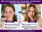 88  Lactic Acid Peel For Sensitive Skin Peel Natural Glowing Skin