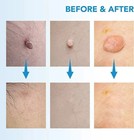 Painless Mole Removal Pen 2-in-1 Auto Micro Skin Tag Wart Remover Device Kit