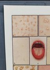 Antique 1912 Human Body Diseases Fever Skin Rashes Mouth Book Print Art Picture
