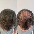 5 - Hair Building Fibers Refill Dark Brown 57g Thinning Hair Concealer