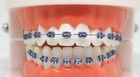 Click Braces     Removable Fashion Braces   Orthodontic-grade Materials   Clip-on