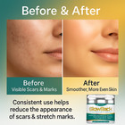Scar Removal Cream For New   Old Scars  Acne  Stretch Marks  Burns - Scar