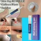3-pack 12 Hours Wart Remover Pen Skin Tag Mole Remover Eliminate Foot Corn Warts