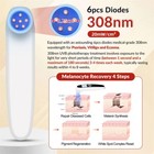 308nm Narrowband Uvb Light Best Blue Light Therapy For Skin Diseases 6diodes