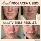 Prosacea - Heals Rosacea Symptoms Of Redness  Pimples - 0 75 Oz  pack Of 2 
