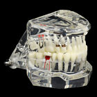 Dental Model Teeth Implant Restoration Bridge Teaching For Study Tooth Sc__f