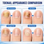 Toenail Repair Solution extra Strength For 1 Fl Oz  pack Of 1   Green