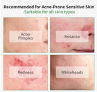 Lanbena Acne Treatment Face Serum  10  Salicylic Acid - Exp 10 26