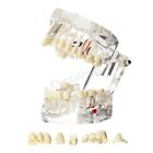 Dental Typodont Teeth Model Overdenture Implant Practice Endo Ortho Teachi Study