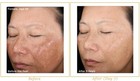 Glycolic Acid 15  Chemical Peel 1 25 Oz  Roll-on Aha Wrinkles Acnes Blackheads