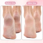 13 Pcs Replacement Roller Heads For Flawless Pedi  Suit For Finishing Touches Fl